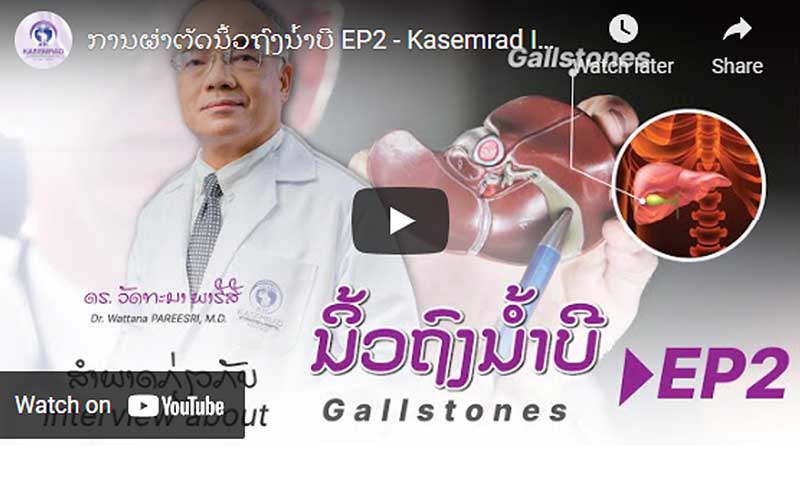 Gallstones EP2